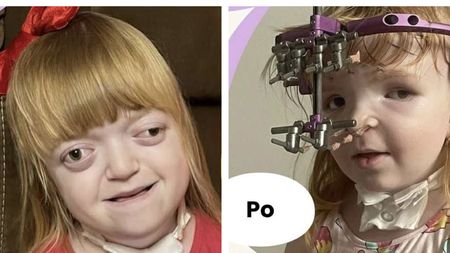 Malá Lilli z Liberecka dostala v Anglii novou tvář. Vytoužená operace za miliony ji mění před očima 